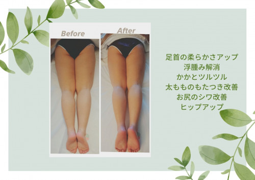 ほうれい線、眉間のしわの改善 (1).jpg