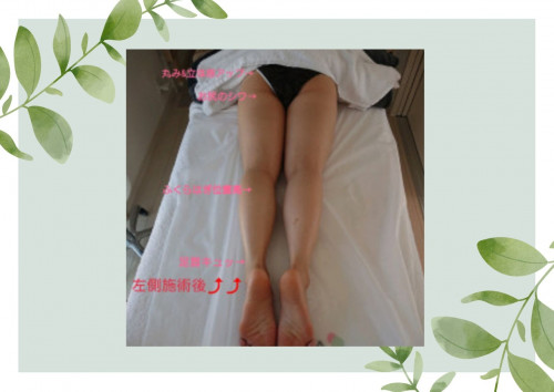 ほうれい線、眉間のしわの改善 (5).jpg