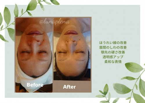 ほうれい線、眉間のしわの改善.jpg