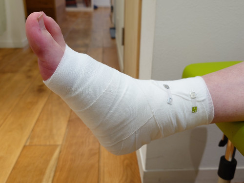 第5中足骨骨折　圧迫固定包帯