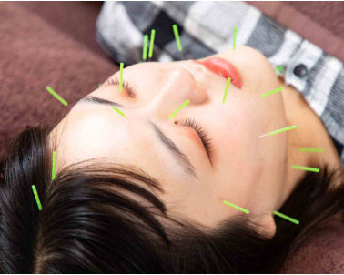 美容鍼も得意です。某有名鍼灸院の技術によりリフトアップと小顔効果。小じわも解消し血色もアップ。10歳若返ります。大変好評を頂いております。