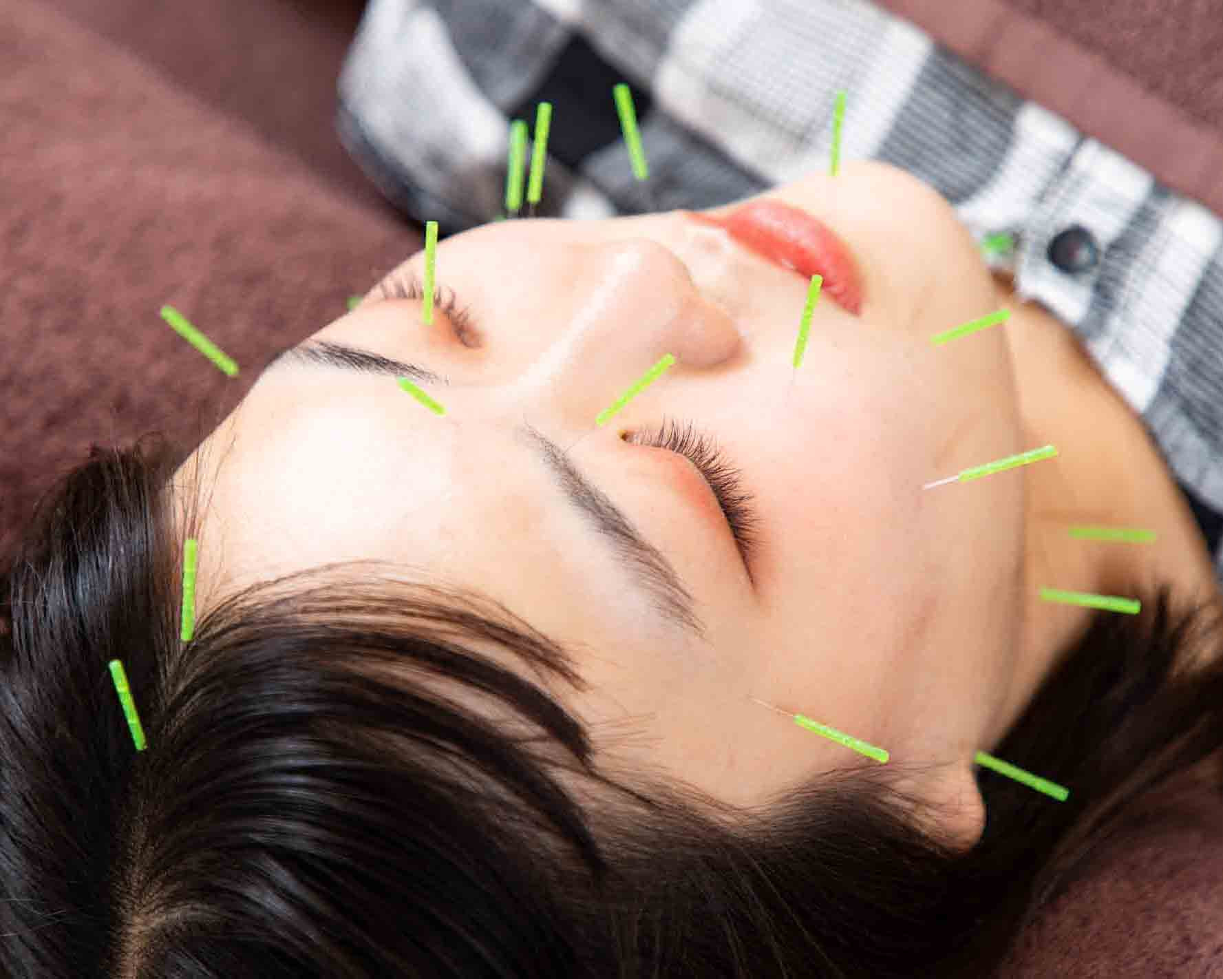 美容鍼も得意です。某有名鍼灸院の技術によりリフトアップと小顔効果。小じわも解消し血色もアップ。10歳若返ります。大変好評を頂いております。