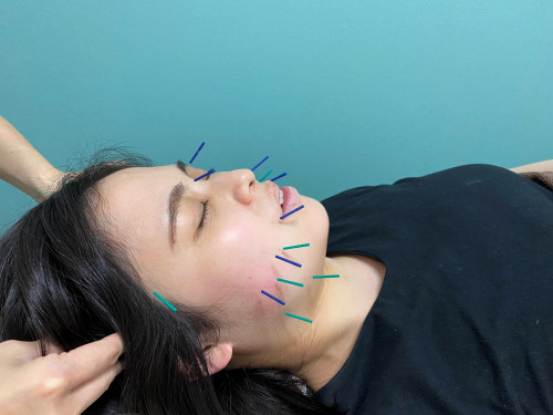 美容鍼.jpg