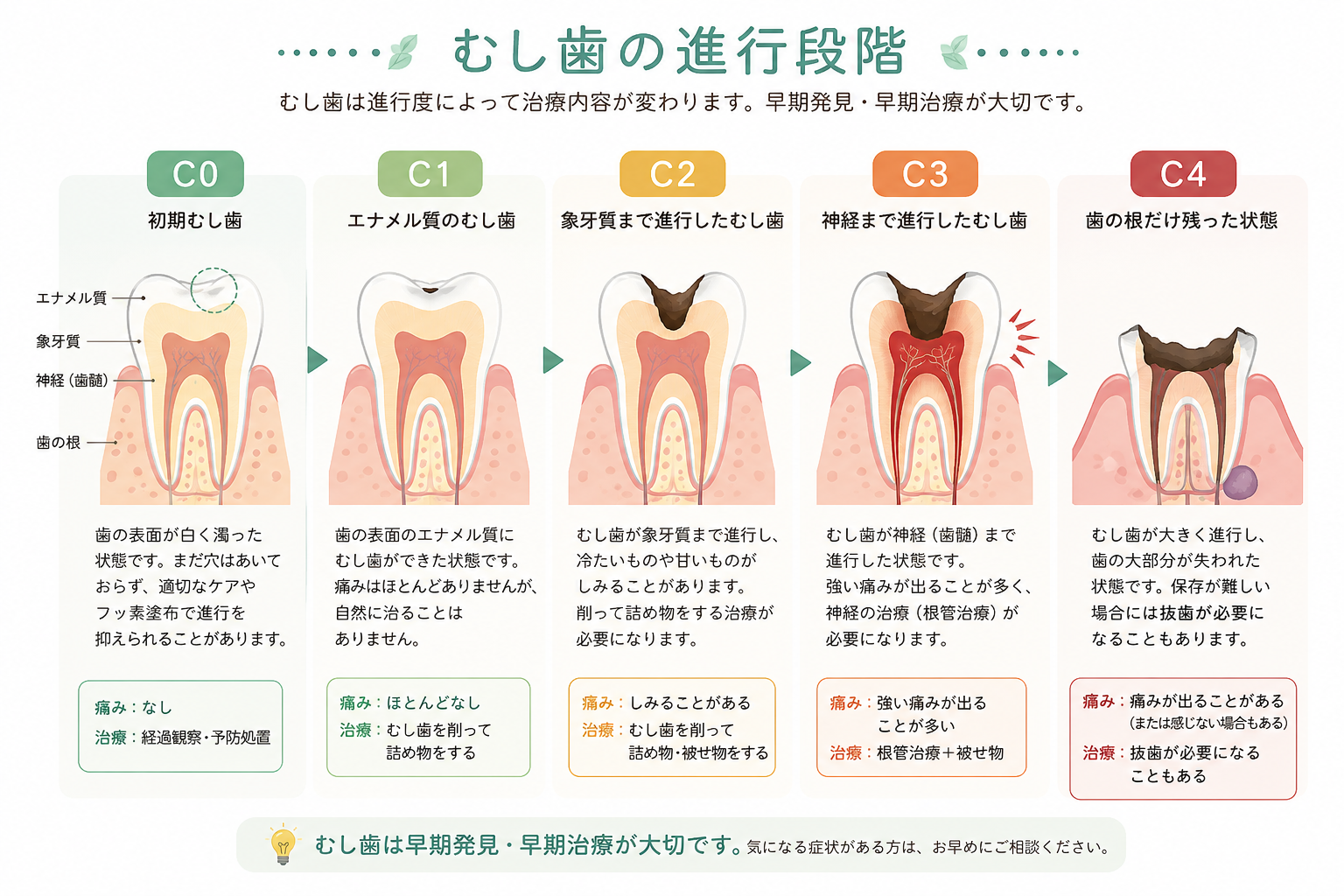 むし歯の進行段階 C0 C1 C2 C3 C4