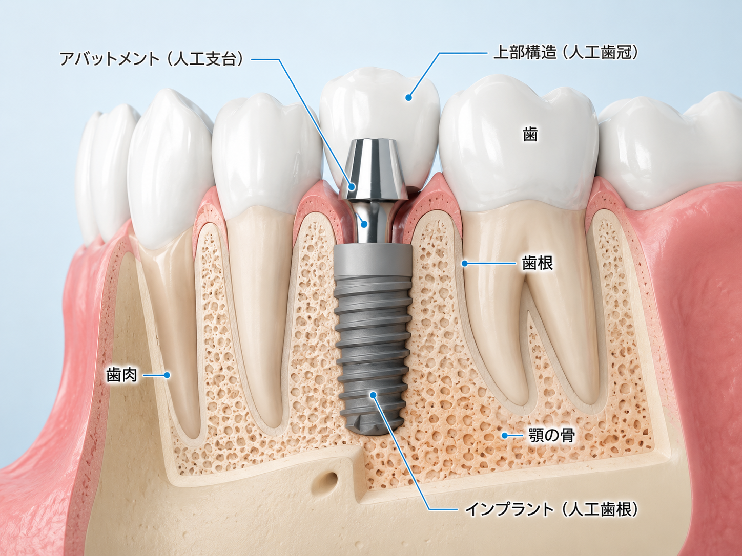 インプラント治療