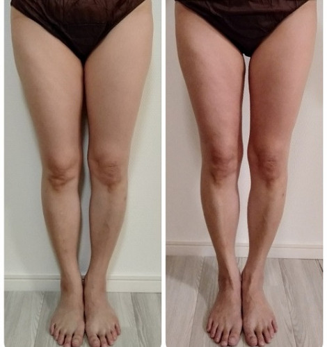 痩身コース　2回