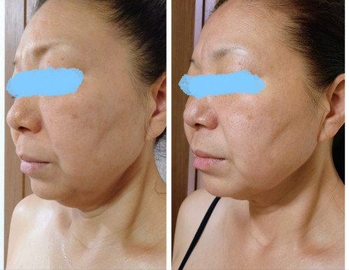 RFサーマルリフト