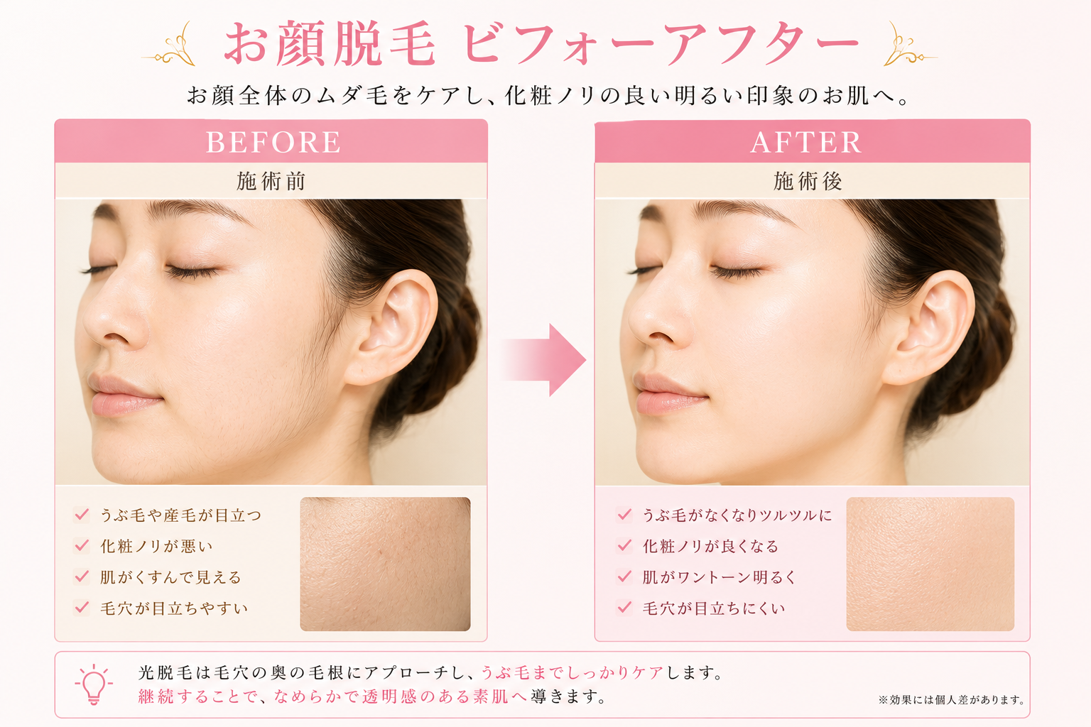 【女性】美肌脱毛で化粧のノリが変わる☆