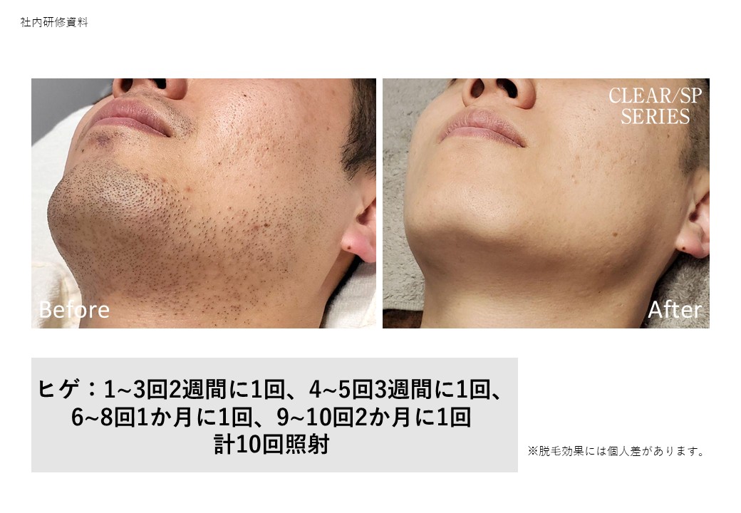 【男性】髭脱毛　最新THR脱毛で、剛毛までしっかりアプローチ。