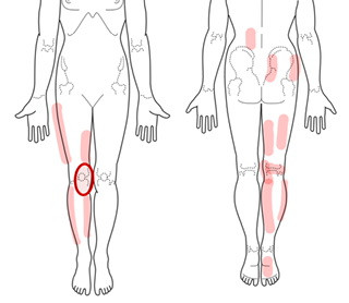ひざの痛みとトリガーポイント
