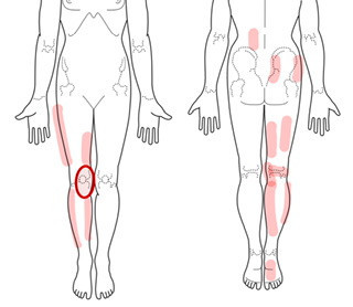 ひざの痛みとトリガーポイント