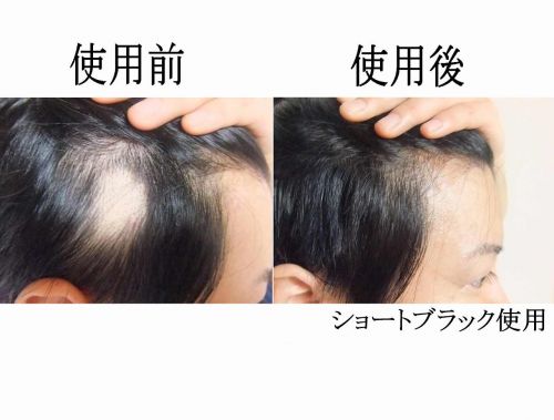 円形脱毛症隠す 部分かつら ショートヘアー用チュールキュア各サイズ 低刺激の専用シール40個付属 本体裏地はさらさら撥水生地 円形脱毛症隠すharu Haru 円形脱毛ここまで隠せてこの安さ 円形脱毛症隠し 隠し方ならチュールキュアウィッグ