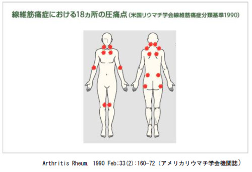 線維筋痛症18圧痛点（PNG).PNG